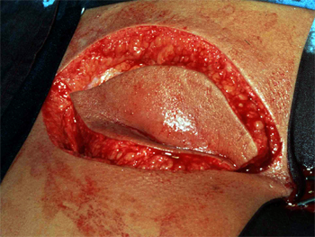 sinus-Ausschneidung