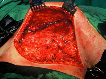 sinus-lappemmobilisation